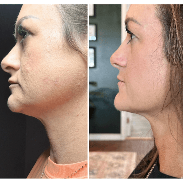 30% off 3 HIFU Face & Neck Sessions at Pura Vita LLC in Sumrall, MS