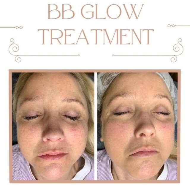 Three BB Glow Treatments at Pura Vita LLC in Sumrall, MS